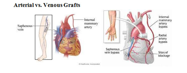arterial venous graft