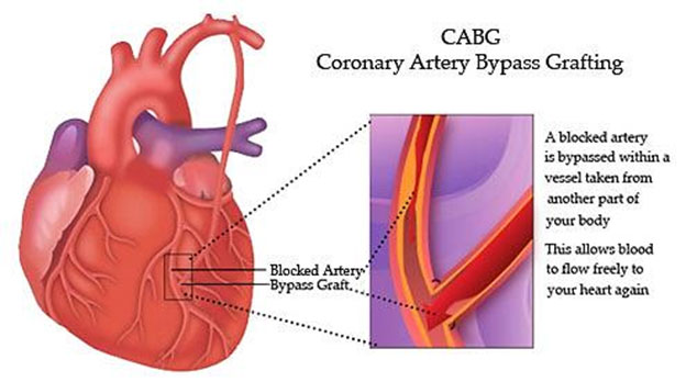 coronary artery disease, coronary artery bypass graft