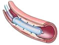 Balloon Angioplasty or percutaneous transluminal coronary angioplasty