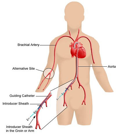 Electrophysiology, catheter, abnormal heartbeats