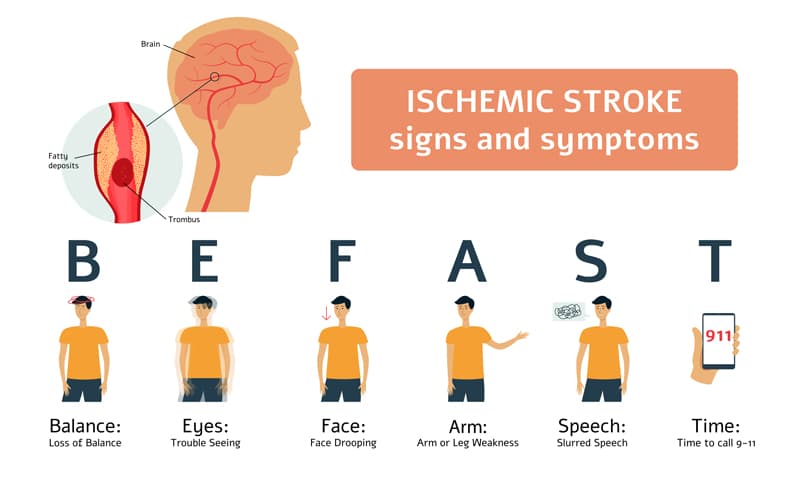 Stroke Symptoms