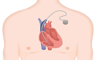 Implantable Cardioverter Defibrillator