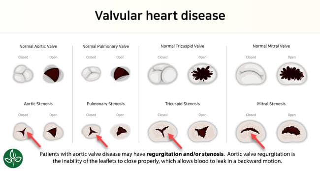 valvular heart disease