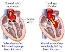 Img_Valvular Regurgitation