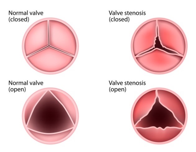 Img_Valvular Stenosis